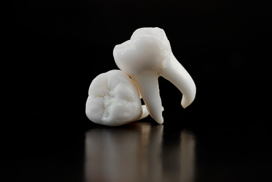 wisdom teeth fort worth
