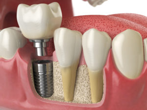 dental implants Fort Worth