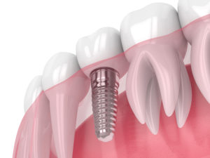 dental implants Fort Worth