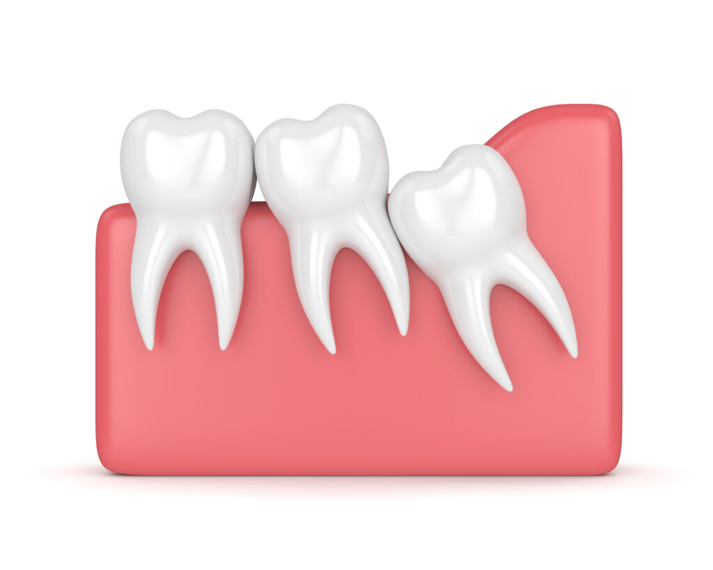 wisdom-tooth-extraction-before-during-after-fort-worth-oral-surgeon