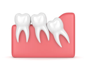 Wisdom Tooth Extraction Before, During, After